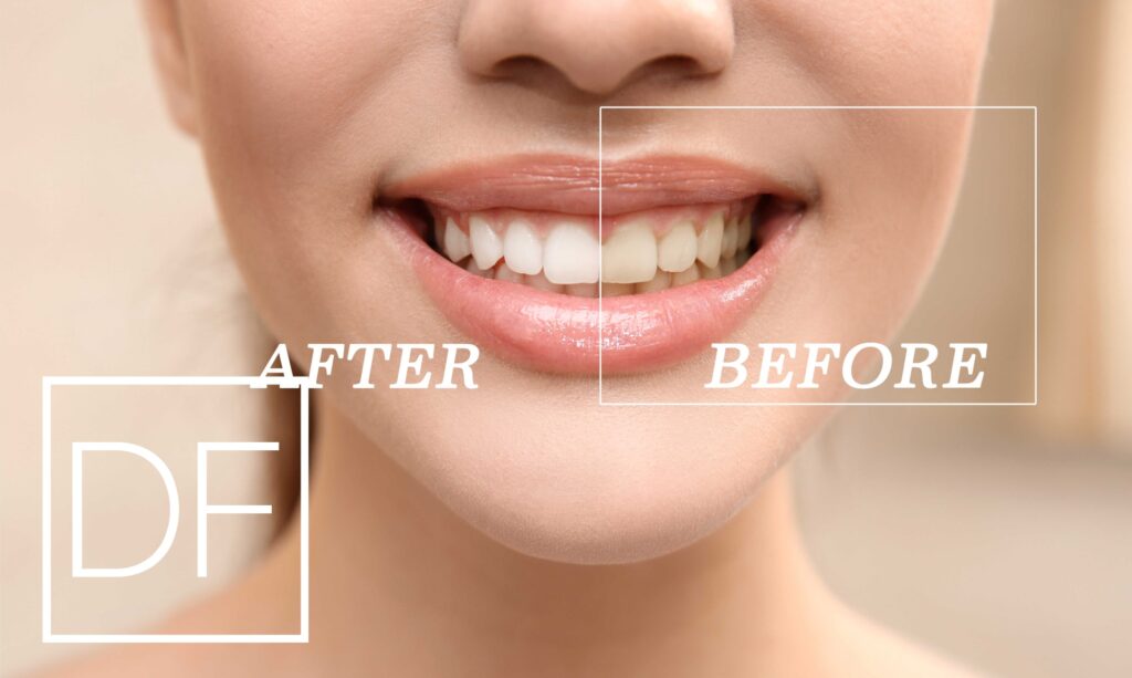 KöR whitening takes care of tooth stains.